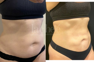 CoolSculpting Elite before and after photo