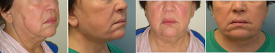 Facelift before and after photo