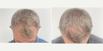 FUE Hair Transplant before and after photo