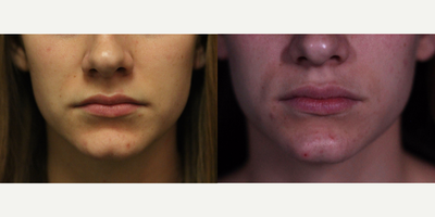 Juvederm before and after photo