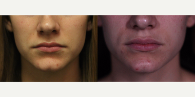 Juvederm before and after photo