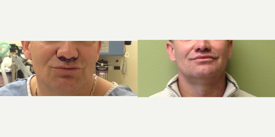 Lip Fillers before and after photo