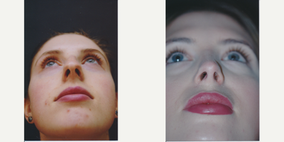 Rhinoplasty before and after photo