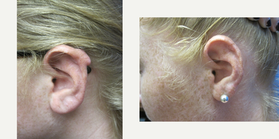 Scar Removal before and after photo