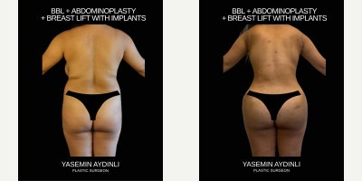 Brazilian Butt Lift before and after photo