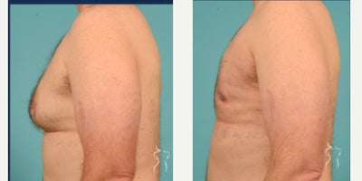 Breast Reduction before and after photo