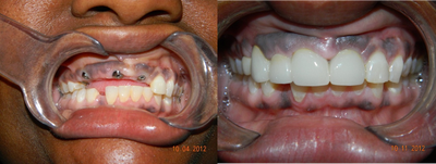 Dental Implants before and after photo