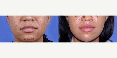 Lip Lift before and after photo