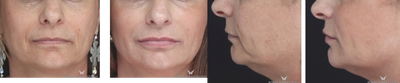 Voluma before and after photo