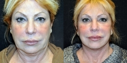 Facelift before and after photo