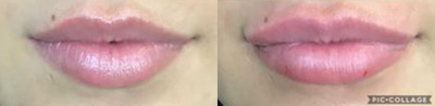 Lip Fillers before and after photo