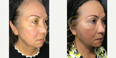Mini Facelift before and after photo