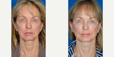 Mini Facelift before and after photo