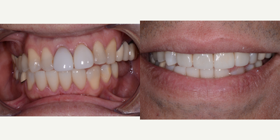 Porcelain Veneers before and after photo