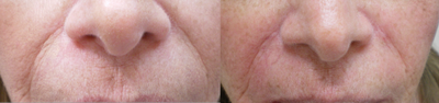 Dermal Fillers before and after photo