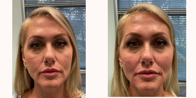 Dermal Fillers before and after photo