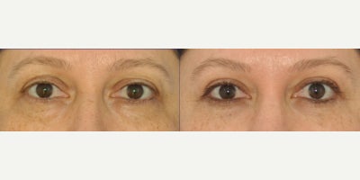 Eyelid Surgery before and after photo