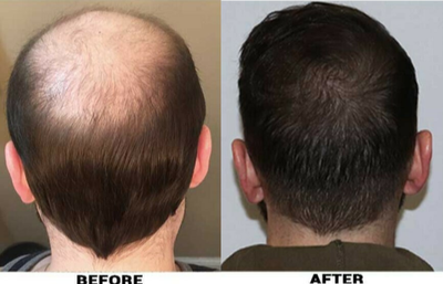 FUE Hair Transplant before and after photo