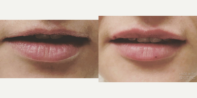 Juvederm before and after photo