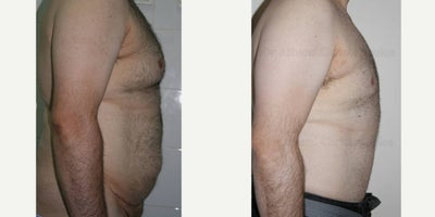 Tummy Tuck before and after photo