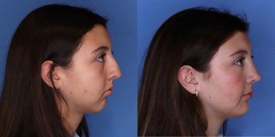 Chin Implant before and after photo