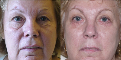 Eyelid Surgery before and after photo