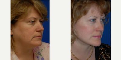 Facelift before and after photo