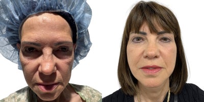 Facelift before and after photo