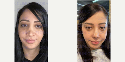 Rhinoplasty before and after photo