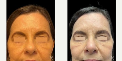 Rhinoplasty before and after photo