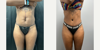 Tummy Tuck before and after photo