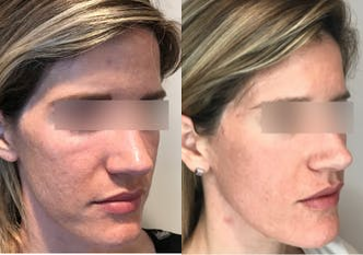 ActiveFX before and after photo