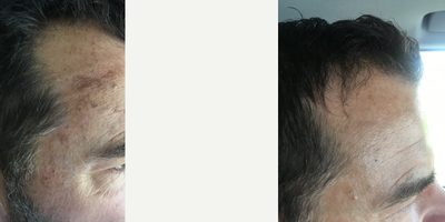 BroadBand Light (BBL) before and after photo