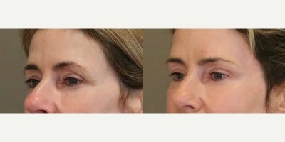Brow Lift before and after photo