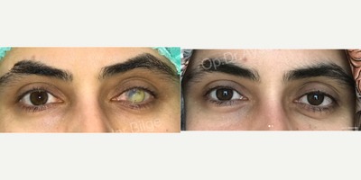 Prosthetic Eye before and after photo