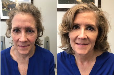 Restylane Lyft before and after photo