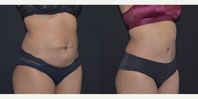 Tummy Tuck before and after photo