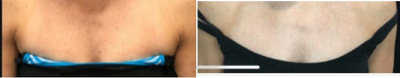 BroadBand Light (BBL) before and after photo