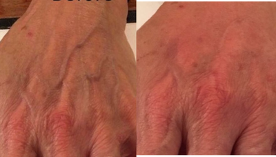 Hand Rejuvenation before and after photo