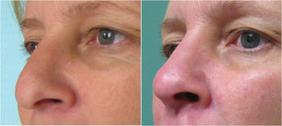 Radiesse before and after photo