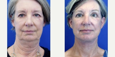 Deep Plane Facelift before and after photo