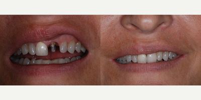 Dental Implants before and after photo