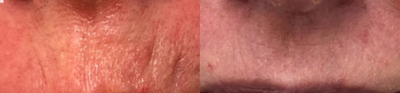 Dermal Fillers before and after photo
