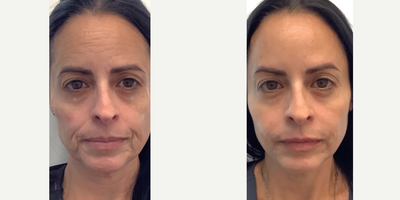 Dermal Fillers before and after photo