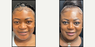 Rhinoplasty before and after photo
