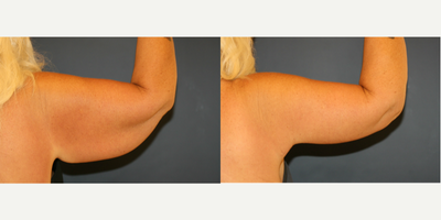 Arm Lift before and after photo