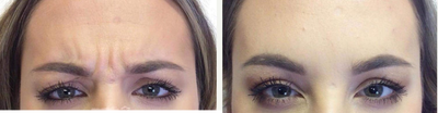 Botox before and after photo