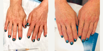 Dermal Fillers before and after photo