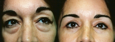 Eyelid Surgery before and after photo