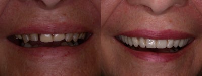 Smile Makeover before and after photo